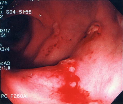 Figure 3 Colonoscopy revealed bleeding from ulcers after endoscopic band ligation.