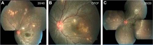 Figure 1 Fundus pictures of the left eye of an 11-year-old child who presented with blurred vision.