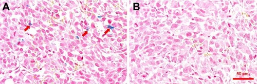 Figure 7 Prussian blue staining of tumor sections.Notes: Prussian blue-stained tumor tissue section from mice treated with SPIO/DSPE-PEG5k-(Bom&Cy5) nanomicelles (A) and SPIO/DSPE-PEG5k-Cy5 nanomicelles (B), respectively. The red arrows indicate SPIO nanoparticles. Scale bar =50 µm.Abbreviation: SPIO, superparamagnetic iron oxide.