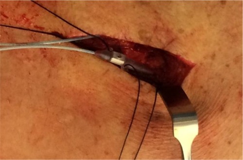 Figure 3 Intraoperative image of NX3000 anchor system by Nevro Corp.