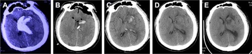 Figure 6 Pre- and post-operation CT scans of an intraventricular hemorrhage that was evacuated by neuroendoscopy.