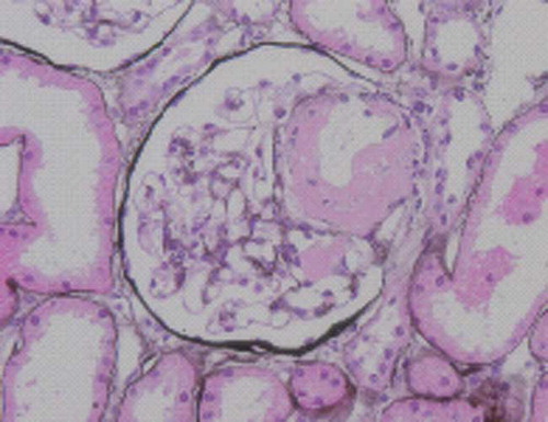 Figure 1. Eosinophilic hyaline deposits were seen in the mesangium and afferent arteriolar wall. Jones methenamine silver stain, original magnification ×400.