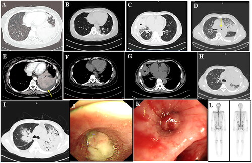 Figure 1. (A,E) Shadow of the left lower lobe, left pleural effusion; (B,F) Nar shadow of the left lower lobe (C,G). The middle lobe of the right lung is incomplete, with internal bronchial inflation and cavity, and right pleural effusion. (D) Irregular mass shadow of the left superior lobe and narrow left main bronchus. (H) Diffuse density increase shadow in the left lung and inflatable bronchial shadow. (I) large solid lesions, even on the left, with bronchial inflation, (J) The left main bronchial terminal mass completely blocked the official lumen, indicating attachment of necromass. (K) The opening of the right middle lobe is completely blocked. (L) The skull is concentrated in multiple parts, including the 12th thoracic vertebra, the first lumbar spine, multiple heel ribs, and a small tablet imaging agent with concentrated poly shadow.