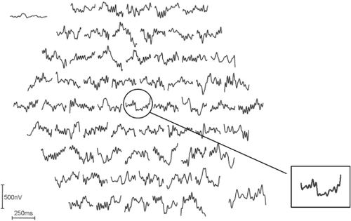 Figure 2 The multifocal visual evoked potentials recorded from the amblyopic right eye of the same subject in Figure 1. The inset shows the pathologic foveal trace with decreased amplitude and increased latency.