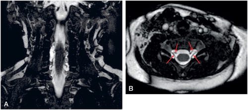 Figure 4. Coronal (A) and axial (B) BFFE image (0.5 mm) in 3-month-old boy (patient 31) with brachial plexus birth injury on both sides. (b) Intact ventral and dorsal nerve roots (red arrows) at C7 level despite a PMC clearly visible on both sides.