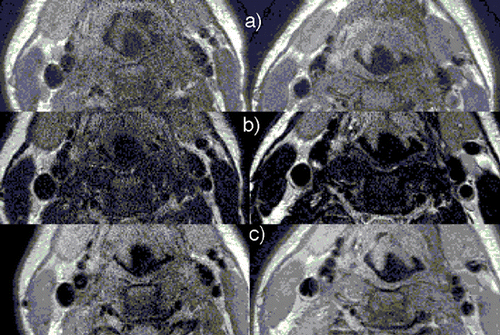 Figure 1. (a) T1, (b) T2 and (c) PD weighted BB images of the carotids are shown here. Images on the left column are from SENSE Flex M coil and the one right are SENSE Flex‐S. (View this art in color at www.dekker.com.)