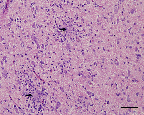 Figure 3.  Medulla oblongata, 4-week-old chicken, experimentally infected with Nevada cormorant strain. 9 d.p.i. Necrotic neurons undergoing phagocytosis (arrow) by many microglial cells. Haematoxylin and eosin. Bar=50 µm.