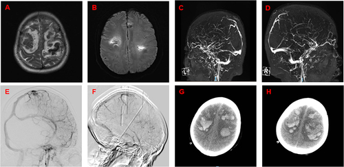 Figure 2 Imaging features of a patient with poor recovery. (A–H) A 29-year-old woman who suffered from cerebral hemorrhage in her first trimester. She was hospitalized with coma caused by cerebral venous sinus thrombosis. Computed tomography showed cerebral hemorrhage (A and B), and magnetic resonance venography revealed superior sagittal sinus thrombosis (C and D). The patient’s condition worsened (G and H) after emergency intervention with thrombolytics and thrombectomy (E and F), eventually leading to her death (Table 3, No. 9).