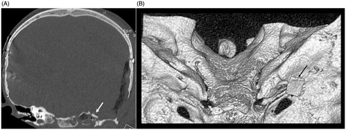 Figure 4. Post-operative coronal CT scan showing bony reconstruction of petrous apex defect (white arrow) (A), and CD reconstruction of the skull base showing the bony reconstruction (black arrow) (B).