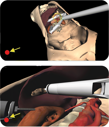 Figure 5. The Computer Guidance Module during a simulated cholecystectomy, working in ACTIVE modality. Throughout the intervention the system continuously monitors the risk of collisions between the robot arms and critical organs surrounding the target of the intervention. If the system detects a robot part approaching a delicate organ, the surgeon is alerted by visual (the red dot in the lower left corner of the screen) and acoustic (a simple beep sequence) warnings. This functionality assists the surgeon during navigation inside the patient's anatomy, overcoming the difficulties associated with the use of the standard endoscopic view. The panoramic view (top) shows the “elbow” of the robot's right arm approaching the pancreas and arterial vessels (critical structures). This dangerous situation is not easily detectable by the surgeon using the standard endoscopic view (bottom).