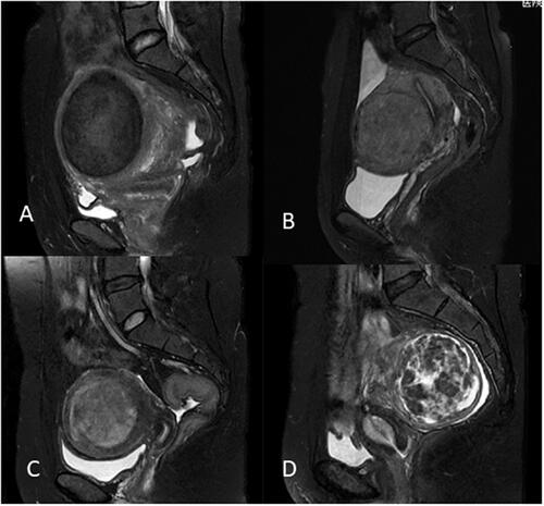 Figure 3. T2-weighted imaging signal intensity of uterine fibroids: (A) homogeneous hypointense. (B) homogeneous isointense. (c) homogeneous hyperintense. (D) heterogeneous hyperintense.