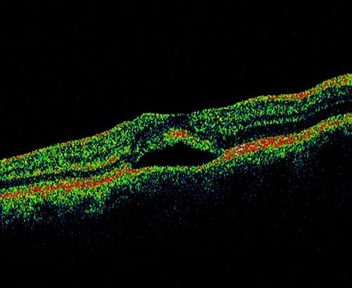 Figure 2 Optical coherence tomography showing an increased thickness of macular area.