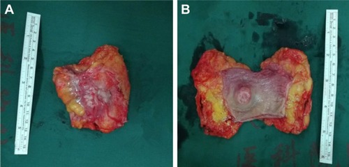 Figure 5 Macroscopic observation of rectal neoplasm.