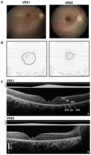 Figure 2 Structural–functional relationships in patients included in the study.Notes: (A) Color fundus images of the right eye of two of the patients. (B) Goldmann kinetic perimetry with large targets (V-4e and IV-4e) in untreated patients demonstrating limited extent of the visual fields (to the central 20–40°) and no perception of smaller targets. (C) 7 mm-long, non-straightened, SD-OCT cross-sections along the vertical (VR21) and horizontal (VR25) meridian through the fovea in two patients. Nuclear layers are labeled (ONL, outer nuclear layer, INL, inner nuclear layer, GCL, ganglion cell layer). Visible outer photoreceptor/RPE sublaminae are labeled (ELM, external limiting membrane; EZ, inner segment/outer segment ellipsoid region) following conventional terminology. T, temporal; N, nasal; I, inferior, S, superior retina. Calibration bar to the bottom left. The images illustrate severe foveal abnormalities and the asymmetric extent of the degree photoreceptor preservation around the foveal center (T > N, S > I) at this stage in patients from this family with RPE65-LCA. Asterisk denotes points to severe foveal ONL thinning with approximation of the EZ band to the RPE (VR21) or interruption (VR25). Bar above the scan show psychophysically determined cone (light-adapted, white stimulus). Dotted line above bar defines lower limit (mean – 2SD) of sensitivity for control subjects. Images illustrate structural functional dissociation with severe retinal dysfunction contrasting with relatively preserved central retinal structure. Adapted with permission from Maguire AM, Bennett, J, Aleman E, et al. Clinical Perspective: Treating RPE65-Associated Retinal Dystrophy. Mol Ther. 2021;29(2):442-463.Citation5 