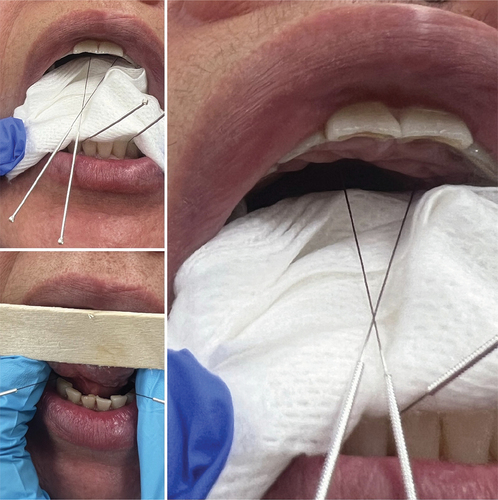 Figure 4. Intraoral acupuncture needle placement.