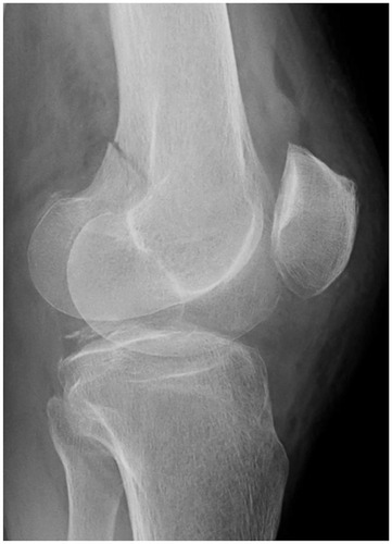 Figure 1 Plain X-ray. Plain X-ray showing a fracture in the left distal femur without dislocation.