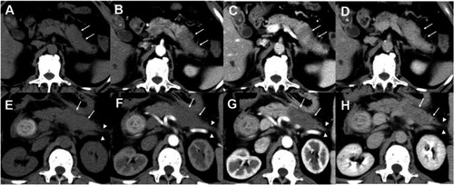 Figure 4 A 57-year-old man with chronic mass-forming pancreatitis. Unenhanced (A), arterial (B), portal venous (C), and delayed phase (D) images show a well-defined mass (arrows) in the body of the pancreas. The CT attenuation of each phase was 36, 59, 87, and 92 HU, respectively. The tumor presented a gradual enhancement pattern with no distal pancreatic parenchyma atrophy. A 68-year-old man with pancreatic ductal adenocarcinoma. Unenhanced (E), arterial (F), portal venous (G), and delayed phase (H) images show a well-defined mass (arrows) in the body of the pancreas. The CT attenuation of each phase was 35, 38, 46, and 58 HU, respectively. The tumor presented a hypovascular enhancement pattern with distal pancreatic parenchyma atrophy (arrowheads).Abbreviations: CT, computed tomography; HU, hounsfield unit.