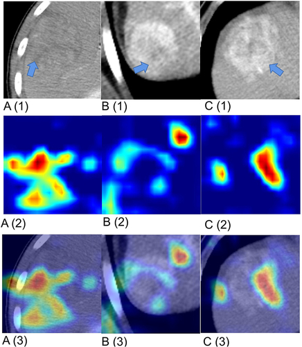 Figure 6 Examples of CT images (A), Heatmap (B), and their corresponding gradient-class activation maps (C) on the validation cohort. On both the heat map and the gradient class activation map, red areas indicate that the area may be associated with a high probability of survival for the patient, while blue lesions indicate a low probability of survival. (A) A 64-year-old woman with 4 years of survival after TACE and Ct-based deep learning survival prediction model activation focused on the tumor region. (B) A 52-year-old male with no internal tumor activation and a disease-free survival of 240 days. (C) The patient with the incorrect prediction, a 48-year-old male, survived 397 days after surgery. The model predicted low risk; however, death occurred after 1254 days.