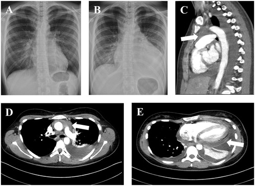 Figure 1. A chest radiograph (A) showing the normal-sized heart in the radiograph taken almost two and a half years before the patient was referred to our institution. The heart in the radiograph (B) obtained two days after the first appointment in the primary health care center showed an enlarged heart profile. There was an upper mediastinal mass posterior to the sternum (arrows in images C and D) evident in the computed tomography (CT) scan. The mass presented with higher Hounsfield unit values than the pleural or pericardial effusion suggesting that it was solid tissue. The pericardium was enhanced on the CT scan (arrow in image E).