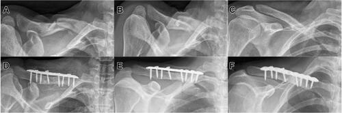 Figure 4 Delayed union after non-surgical treatment of an Allman type 1 fracture; (A) axial radiograph of a little displaced shaft fracture; (B) axial radiograph at 2 months revealing delayed union; (C) anterior-posterior (AP) radiograph confirming delayed union; (D) axial radiograph following surgical intervention with resection of the delayed union and debridement, ORIF and filling of the residual bone defect with CERAMENT G; (E) axial radiograph and (F)AP radiograph at 12 months showing excellent bony union.