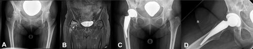 Figure 3 Idiopathic femoral head necrosis with metaphyseal involvement ARCO III–IV (A and B). 4-year follow-up shows good osteointegration of the Metha® stem and slight calcar rounding (Engh I) (C and D).