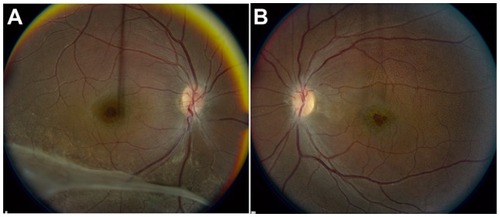 Figure 1 Color fundus photographs of Case 1. The right eye (A) demonstrates a cystic spoke-like appearance to the fovea and the presence of a vitreous veil inferiorly. The left eye (B) demonstrates an area of focal foveal thinning, as well as multiple white dots throughout the macula.