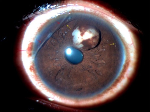 Figure 1 Slit-lamp photograph of the anterior segment at presentation showing iris cyst, two eyelashes in the anterior chamber (yellow arrows) and linear corneal opacity (red arrows).