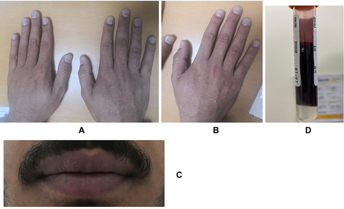 Figure 1 Showed cyanosis of the hands, fingers and lips(A–C). Also, it showed dark brown color blood (D). These finding are common manifestation of congenital methemoglobinemia.