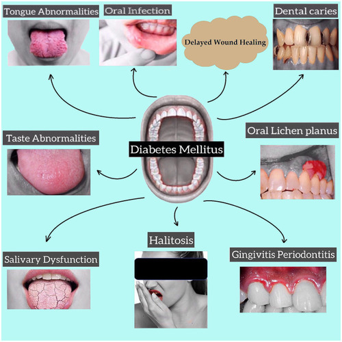 Figure 1 Complications of oral cavity in diabetes mellitus.