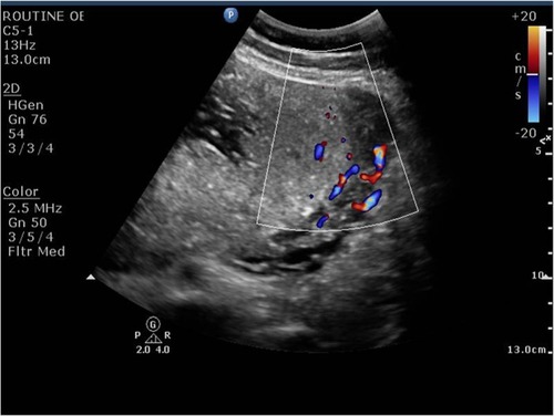 Figure 4 Doppler of the myometrial placental junction showing an improvement in flow after starting sildenafil citrate.