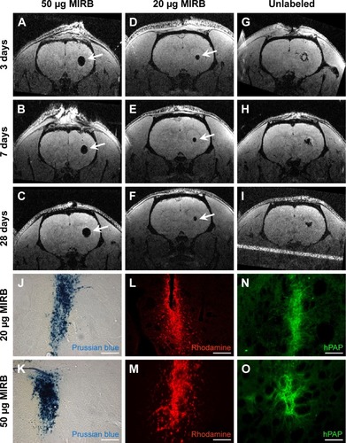 Figure 4 Extended in vivo tracking of MIRB-labeled NSCs.Notes: We transplanted control (unlabeled), 20 μg or 50 μg MIRB-labeled NSCs into the striata of adult rats, and imaged the animals longitudinally over a period of 1 month. Distinct and typical signal dropout (arrows, indicating iron oxide-labeled cells) in the striatum was noted at 3, 7, and 28 days post-transplantation in animals receiving the 20 μg or 50 μg MIRB-labeled NSCs but not unlabeled cells (A–I). Also, the observed signal dropouts in the 50 μg animals were significantly stronger than in 20 μg animals. Upon later histological examination, areas corresponding to the regions where the signal dropout were noted in 20 μg and 50 μg MIRB animal groups showed the clear presence of hPAP+-grafted NSCs (N and O) which could be visualized via rhodamine fluorescence (L and M) as well as Prussian blue staining (J and K). Scale bars: 200 μm.Abbreviations: MIRB, Molday ION Rhodamine B; NSC, neural stem cell.