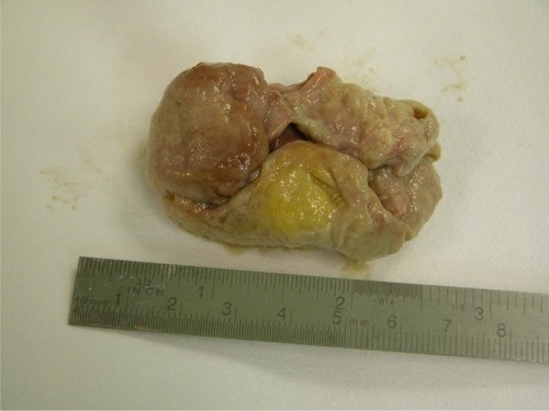 Figure 1 Relatively large necrotic fibroid spontaneously expulsed transcervically 3 weeks after uterine artery embolization.