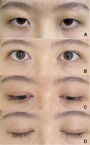 Figure 5 Patient 2. (A) Preoperative view of a 22-year-old female who underwent double-eyelid blepharoplasty with TOS fixation and epicanthoplasty. Postoperative views at twelfth month with her eyes open (B), eyes gazing downward (C), and eyes closed (D).