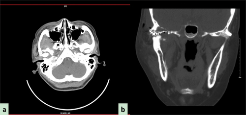 Figure 7. Computed tomography (CT) examination conducted 3 months postoperatively confirmed no signs of recurrence. (a) Axial plane; (b) coronal plane.