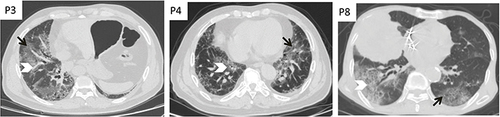 Figure 1 Diffuse pattern. Non-contrast chest CT demonstrating the presence of multiple, bilateral multiple ground glass opacities (Black arrow) mixed with large areas of consolidation (White arrow head) in the both pulmonary lobes.