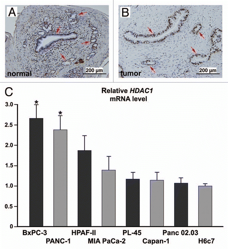 Figure 4 Expression of HDAC1 is upregulated in human pancreatic adenocarcinoma tissues and cells. (A and B) Immunohistochemical analysis of HDAC1 protein in normal pancreatic tissue and pancreatic adenocarcinoma obtained from different regions of the pancreas from the same patient. These images are representative of the normal-tumor pairs of pancreatic tissues from five patients. Red arrows point at the nuclei of the ductal cells. Pre-immune serum was used as control for specificity of anti-HDAC1 antibodies (data not shown). (C) Quantitative analysis of HDAC1 mRNA in human pancreatic adenocarcinoma cell lines by real-time PCR. Each value represents the relative HDAC1 mRNA level in the cell line as compared with that in H6c7. Each column represents the mean and the bars represent SD, as determined from three independent experiments. *Indicates statistically significant difference relative to H6c7.