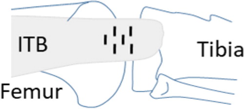 Figure 1. Schema to perform pie-crusting cuts on the ITB.