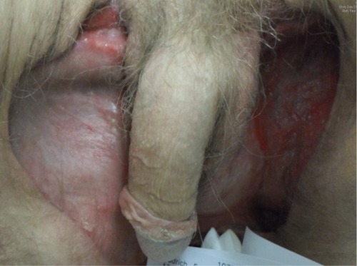 Figure 7 The situation close to patient’s release: the wound shows granular tissue formation and is without any visible necrotic areas.