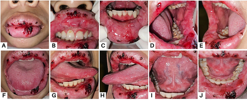 Figure 1 Oedema of the upper and lower lip with hemorrhagic crusts and bleeding easily (A); Multiple irregular ulcer lesions surrounded by erythema areas: Upper labial mucosa (B); Lower labial mucosa (C); Left buccal mucosa (D); Right buccal mucosa (E); Tongue dorsum (F); Right lateral tongue (G); Left lateral tongue (H); Tongue ventral (I); and Floor of the mouth (J).