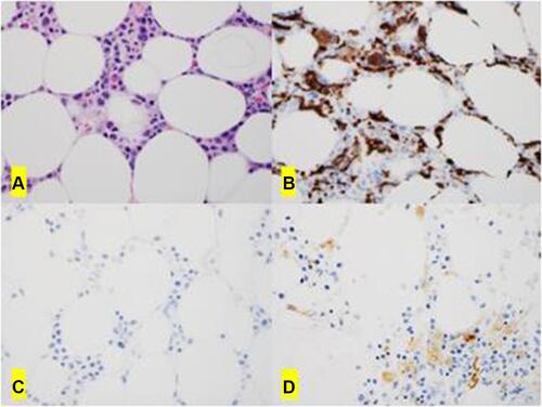 Figure 2 The bone marrow biopsy shows hypocellularity with left-shifted myelopoiesis (A, H&E x 0). Immunohistochemical studies shows increased interstitial macrophages by CD68 (PGM1) (B, x40); they are type 2 macrophages (M2) negative for pSTAT1 (C, x 0) and positive for CD163 (D, x40).