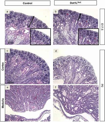 Figure 4. Targeted disruption of Dot1L-H3K79 methyltransferase activity in Six2+ nephron progenitors causes congenital renal dysgenesis. (a, b) PAS-stained sections. E17.5 Dot1LSix2 kidneys display loss of cortical architecture, thinning of the nephrogenic zone, and blood-filled glomerular tufts. (c-f) PAS-stained sections. P0 Dot1LSix2 kidneys show progressive loss of corticomedullary differentiation, glomerular blood extravasation, depletion of the nephrogenic zone, cortical and medullary tubular dilation/cyst-like formation. Consistent with disrupted glomerular architecture, many cortical and medullary dilated tubules contain proteinaceous material. N = 5–7/group