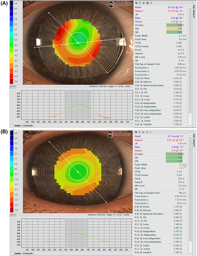 Figure 6 Wavefront Error Zernike Fit maps to measure baseline (A) and over a scleral lens (B) HOAs, detecting any variation or compensation.