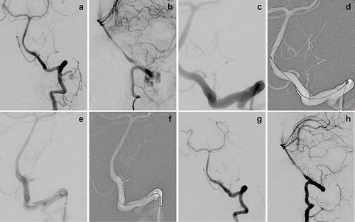 Figure 5 A 50-year-old woman with an iatrogenic left VA rupture. (a–c) The preprocedural DSA image showed that a rupture was located at the V3 segment of the left VA. (d) The microguidewire successfully passed through and reached the distal end of the lesion. (e and f) The WCS was transferred to bridge the fistula on the basis of the roadmap and was successfully deployed. (g and h) Cerebral angiogram immediately after stent deployment showed complete occlusion of the VA rupture without an endoleak.