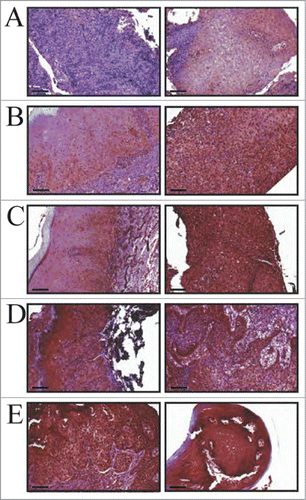 Figure 6. MIEN1 expression in clinical specimens obtained over multiple visits (longitudinal specimens from 4 patients). (A, left) Control IgG negative staining; (A, right) Benign hyperplastic tissue adjacent to the tumor. (B) Patient 1 showing (left) mild dysplasia and (right) squamous cell carcinoma. (C) Patient 2 displaying (left) mild dysplasia and (right) squamous cell carcinoma. (D) Patient 3 and (E) Patient 4 demonstrating (left) severe dysplasia and (right) squamous cell carcinoma. (B-E) Left and right images are representations from 2 different visits. Scale: 20× (100 μm) magnifications.