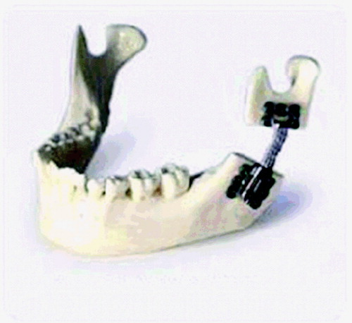 Figure 5. Distraction along a curve. Note that the edges of the bone along the osteotomy are no longer parallel.