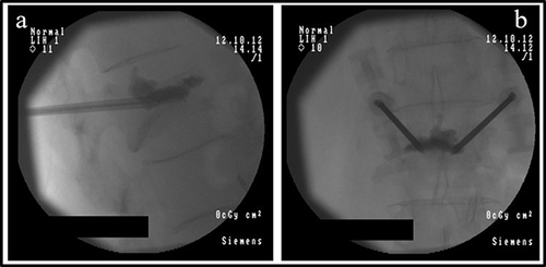 Figure 3 Percutaneous vertebroplasty in a patient with low back pain related to vertebral fracture.