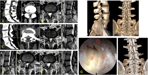Figure 4 A 37-year-old woman’s first visit to the doctor was for “low back pain with numbness and pain in the right lower limb”, and the lumbar CT showed a disc herniation in the L4/5 (A), which was treated with PETD, and the follow-up MR showed that the herniated disc had been removed (B). The patient had a recurrence after 3 years, complaining of low back pain with bilateral lower limbs pain, and the lumbar CT and MR showed a disc herniation at L4/5 with lateral socket stenosis (C). PEID was used for revision, and (G) shows that part of the intraoperative lamina was resected with a visualized circular saw ((① the serration of circular saw, ② the vertebral plate, ③ the ligamentum flavum). (D and E) are postoperative MR on the first day and at 6 months, respectively, showing that the surgery was successful in removing the herniated disc. And (F–H) show the vertebral plates before and after revision.
