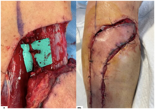 Figure 6. Clinical course throughout the 7 d after flap elevation. (A) The remaining superficial sural vein was clamped with a vascular clip. (B) After 6 h, the flap was clearly congested.