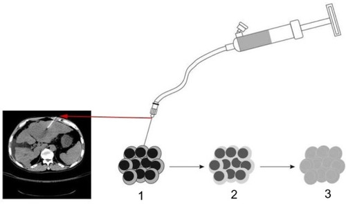 Figure 1 UMIPIC or ITCT procedures with an inflator.