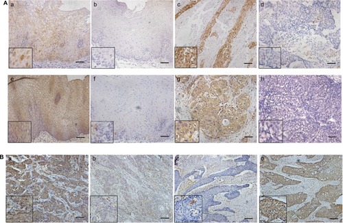 Figure 3 Expression of STAT1 and STAT3 in 30 ESCC samples.Notes: (A) (a) STAT1-high expression in esophageal epithelial. (b) STAT1-low expression in esophageal epithelial. (c) STAT1-high expression in ESCC. (d) STAT1-low expression in ESCC. (e) STAT3-high expression in esophageal epithelial. (f) STAT3-low expression in esophageal epithelial. (g) STAT3-high expression in ESCC. (h) STAT3-low expression in ESCC. (B) In the same ESCC sample (a,b), STAT1 expression is high (a) and STAT3 expression is low (b). In another ESCC sample, STAT1 expression is low (c) and STAT3 expression is high (d). Scale bar: 100 µm.Abbreviations: STAT, signal transducer and activator of transcription; ESCC, esophageal squamous cell carcinoma.